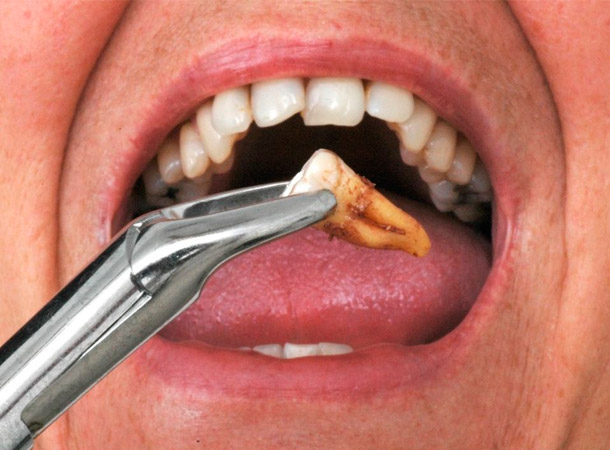 Extrações Dente do Siso