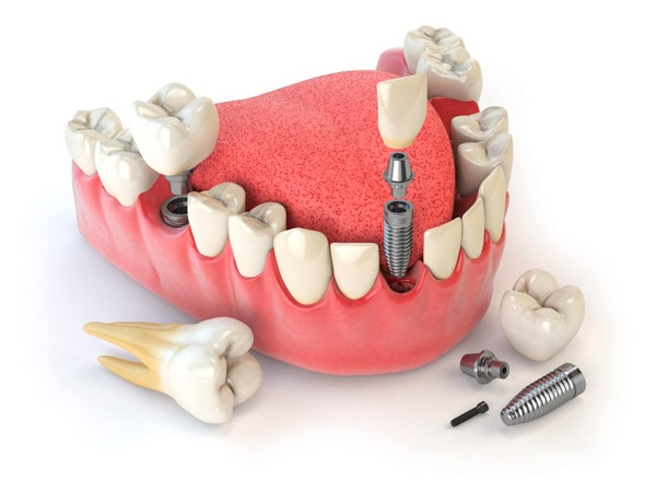 Implantes Dentários